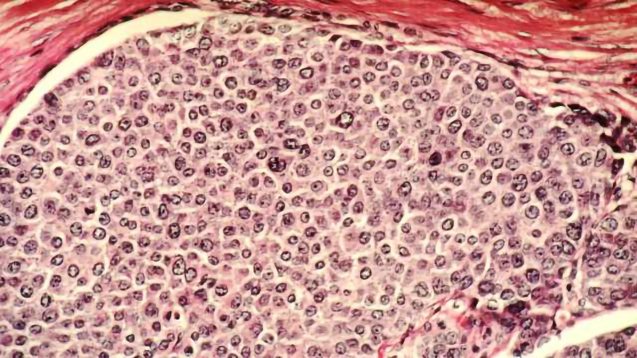Researchers Advocate for Single-Cell Diagnostics for Breast Cancer