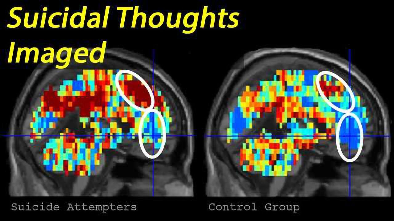 Suicidal Individuals Identified by their Brain Activity