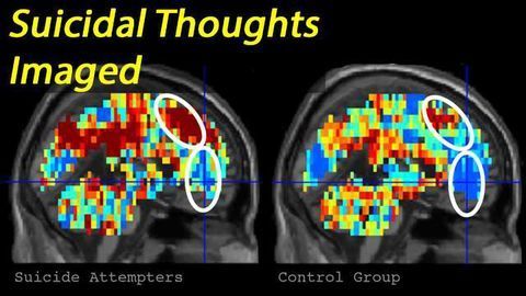 Suicidal Individuals Identified by their Brain Activity