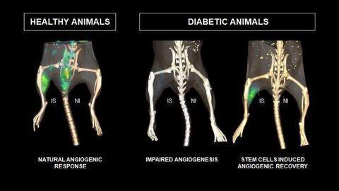 Stem Cells From Muscle Could Address Diabetes-related Circulation Problems