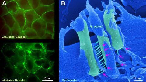 How a Common Bacteria Causes Gastric Bacteria