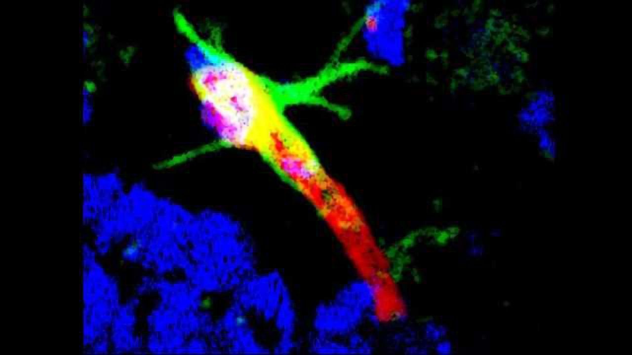 Potential Biomarker for Early Detection of Alzheimer's