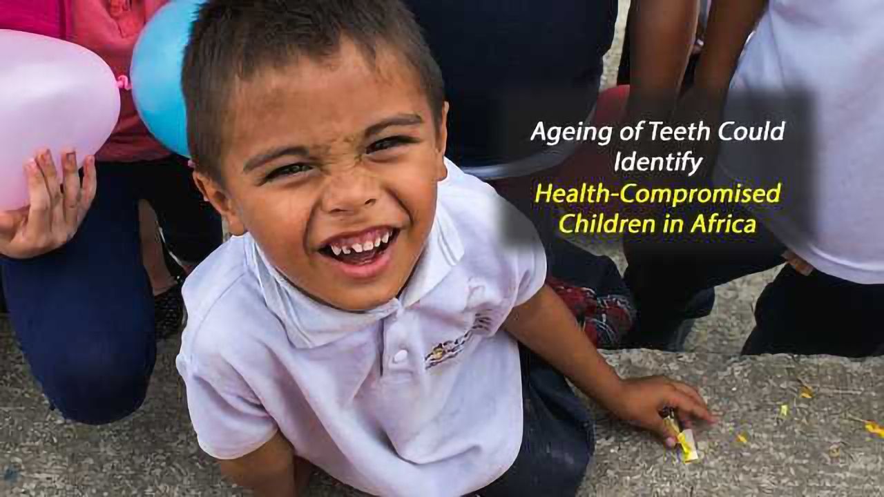 Telling Teeth: More Accurate Ageing of Teeth Could Hold the Key to Identifying Health-Compromised Children in Africa
