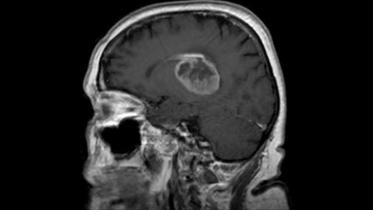 Attacking Telomeres Offers First Effective Glioblastoma Therapy