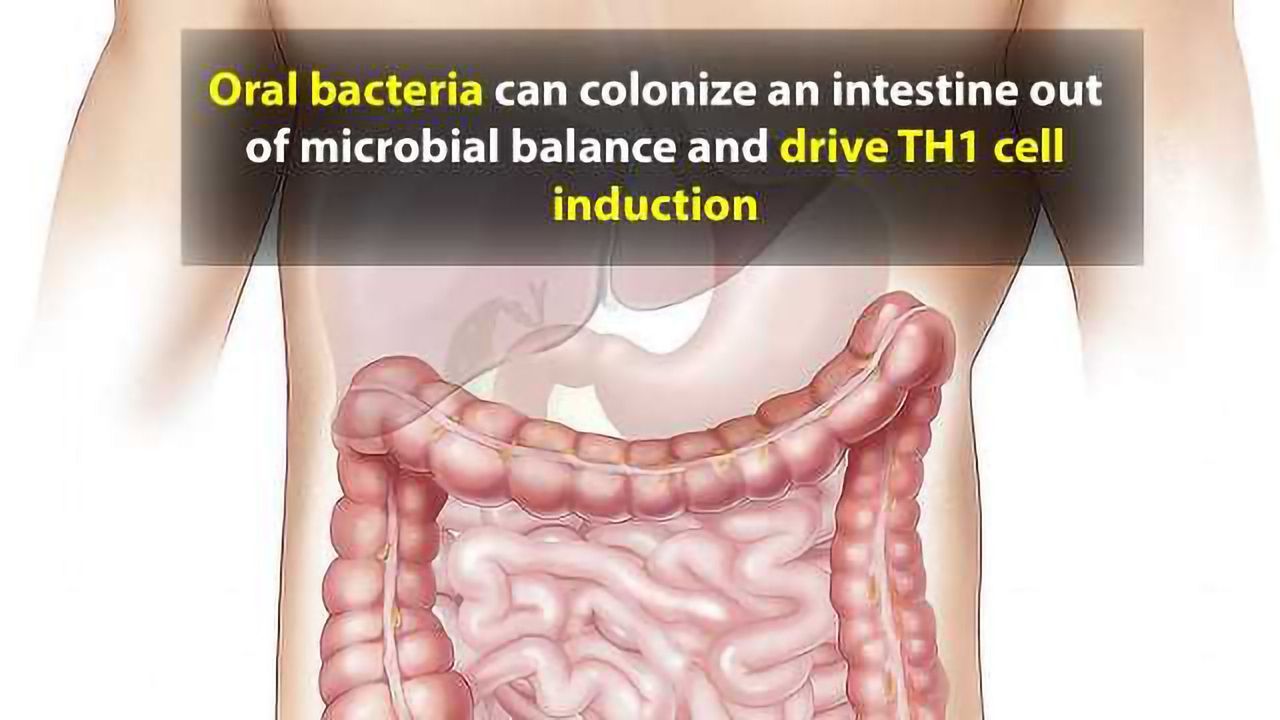 Oral Bacteria in the Gut Could Drive IBD