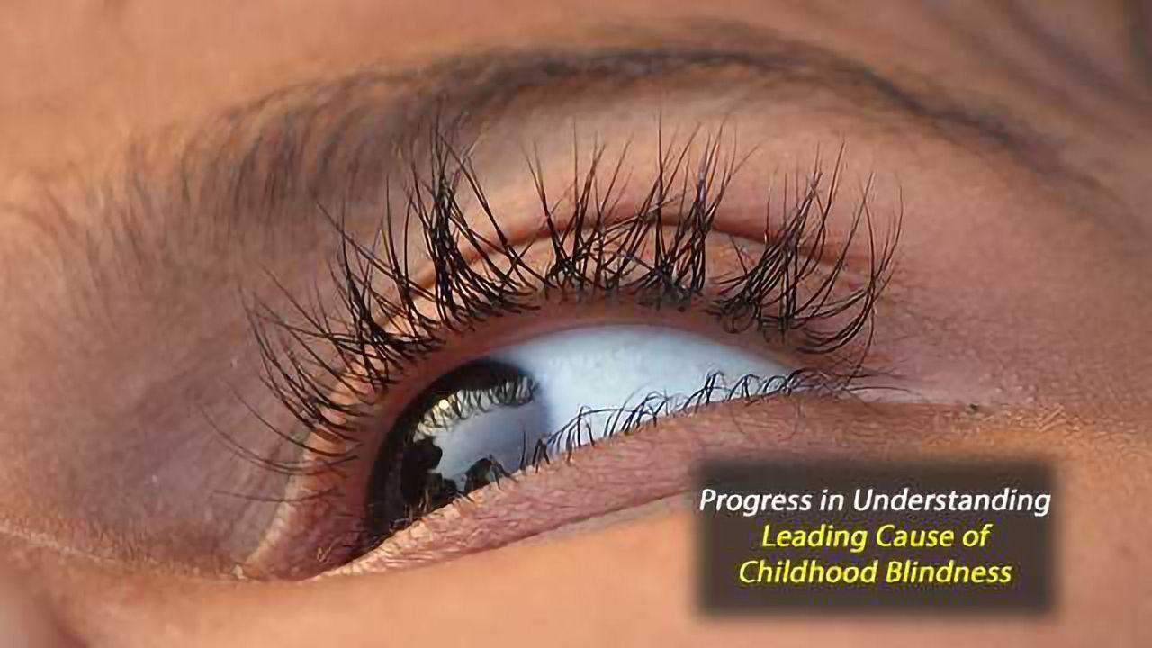 Biological Mechanism of a Leading Cause of Childhood Blindness Revealed