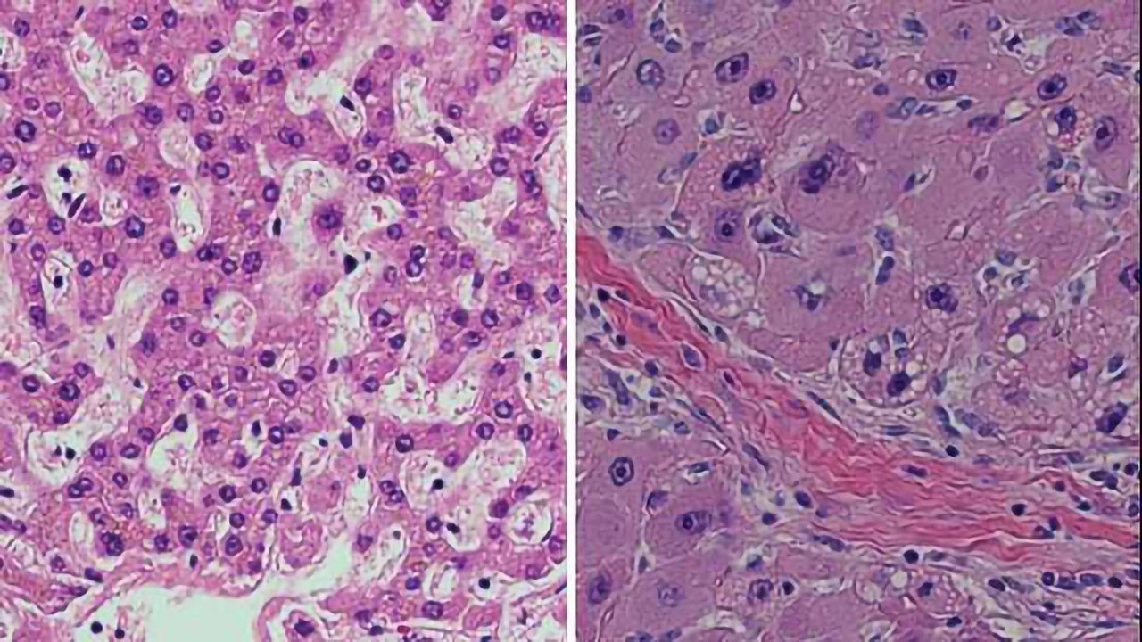 Novel Approach May Aid Rare Liver Cancer Patients