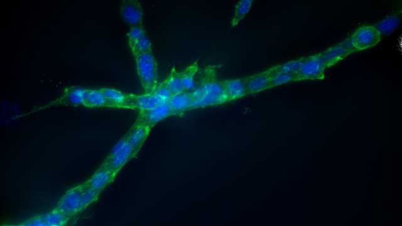 What Makes Cancer Cells Metastasize?