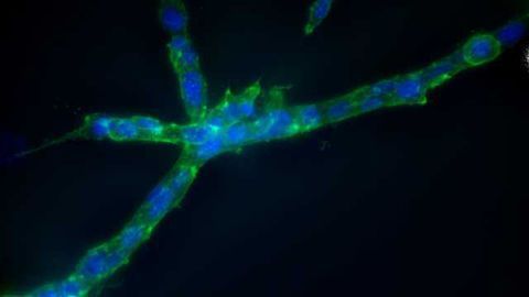 What Makes Cancer Cells Metastasize?