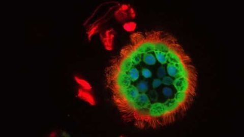 New Simple Test Could Help Cystic Fibrosis Patients Find Best Treatment