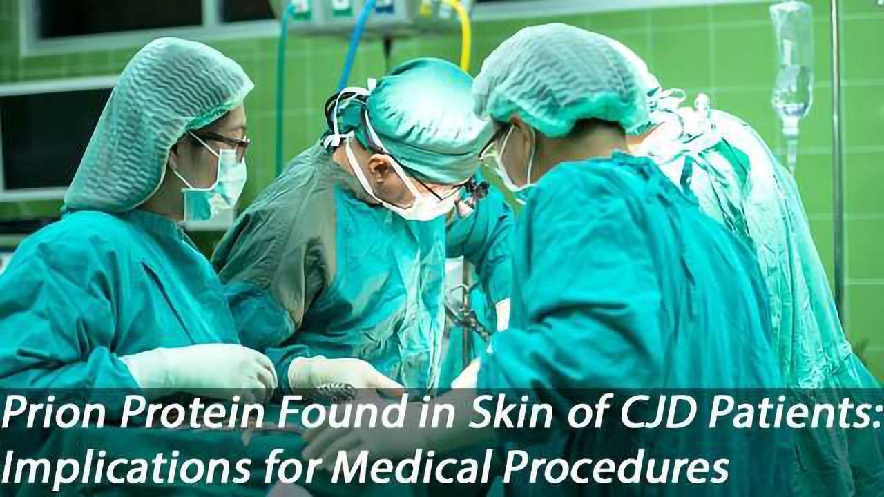 Abnormal Prion Protein Found in the Skin of Patients That Died of CJD