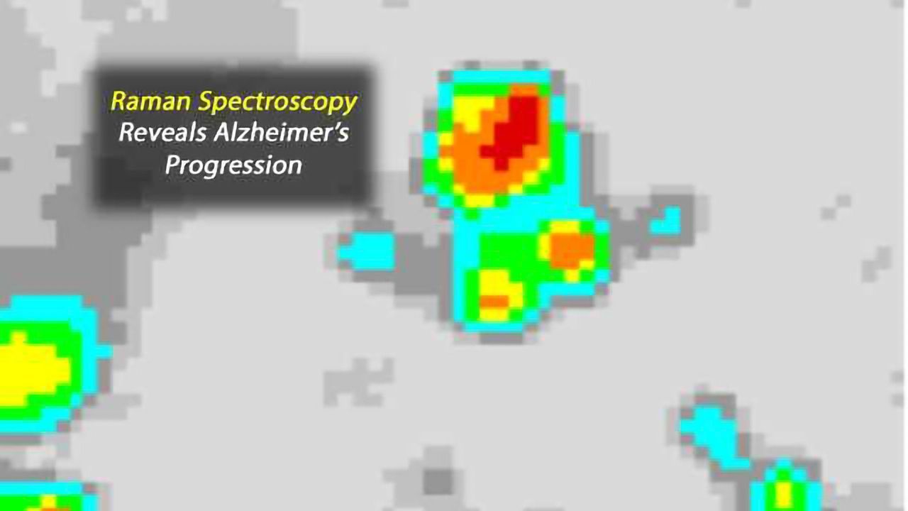 Imaging Technique Shows Alzheimer's Disease Progression