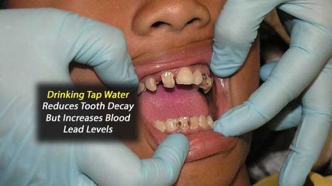 Blood Lead Levels Lower, But Tooth Decay Higher in Children Who Do Not Drink Tap Water