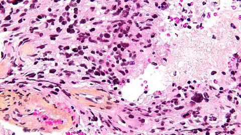 Beactica Awarded Funding to Develop New Therapeutics Against Aggressive Brain Tumours