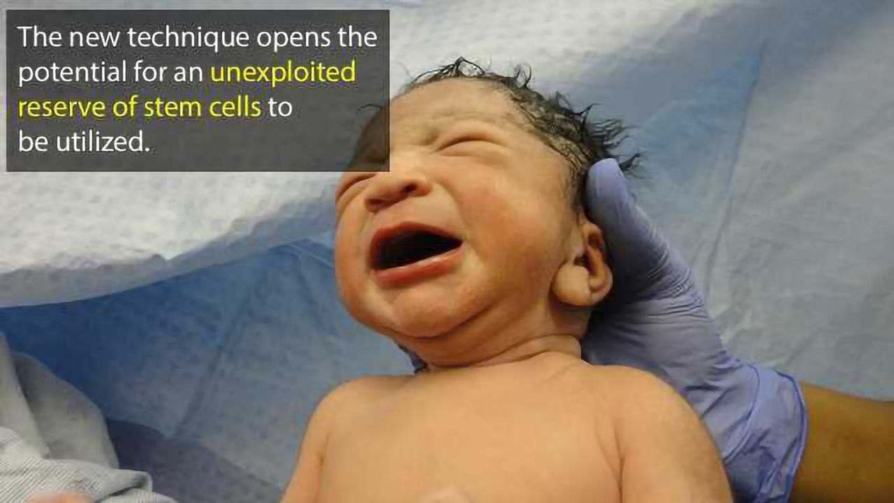 Mesenchymal Stem Cells can be Harvested from Amniotic Fluid During Caesareans