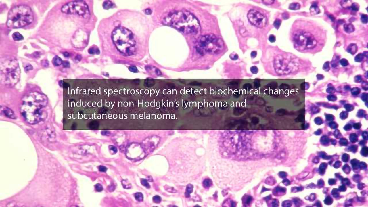 Infrared Spectroscopy Test Can Diagnose Two Cancer Types