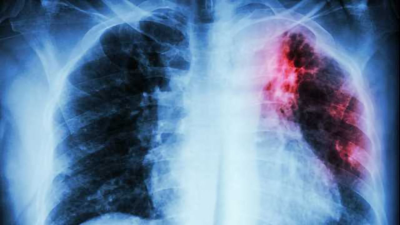 Cancer Gene Plays Key Role in Cystic Fibrosis Lung Infections