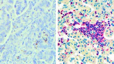 Some Immune Cells May Help Tumors Instead of Destroying Them