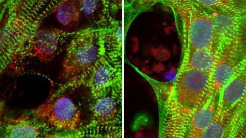Research Reveals How Diabetes In Pregnancy Affects Baby’s Heart