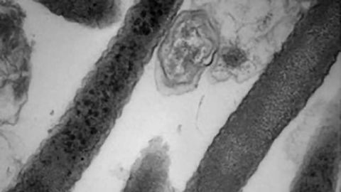 Fusobacterium May Help Colorectal Cancer Grow and Spread