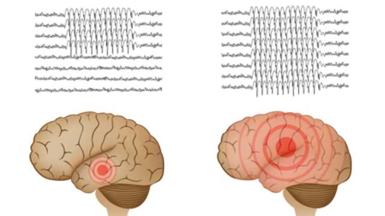 Focal Epilepsy and Depression May Share a Genetic Cause