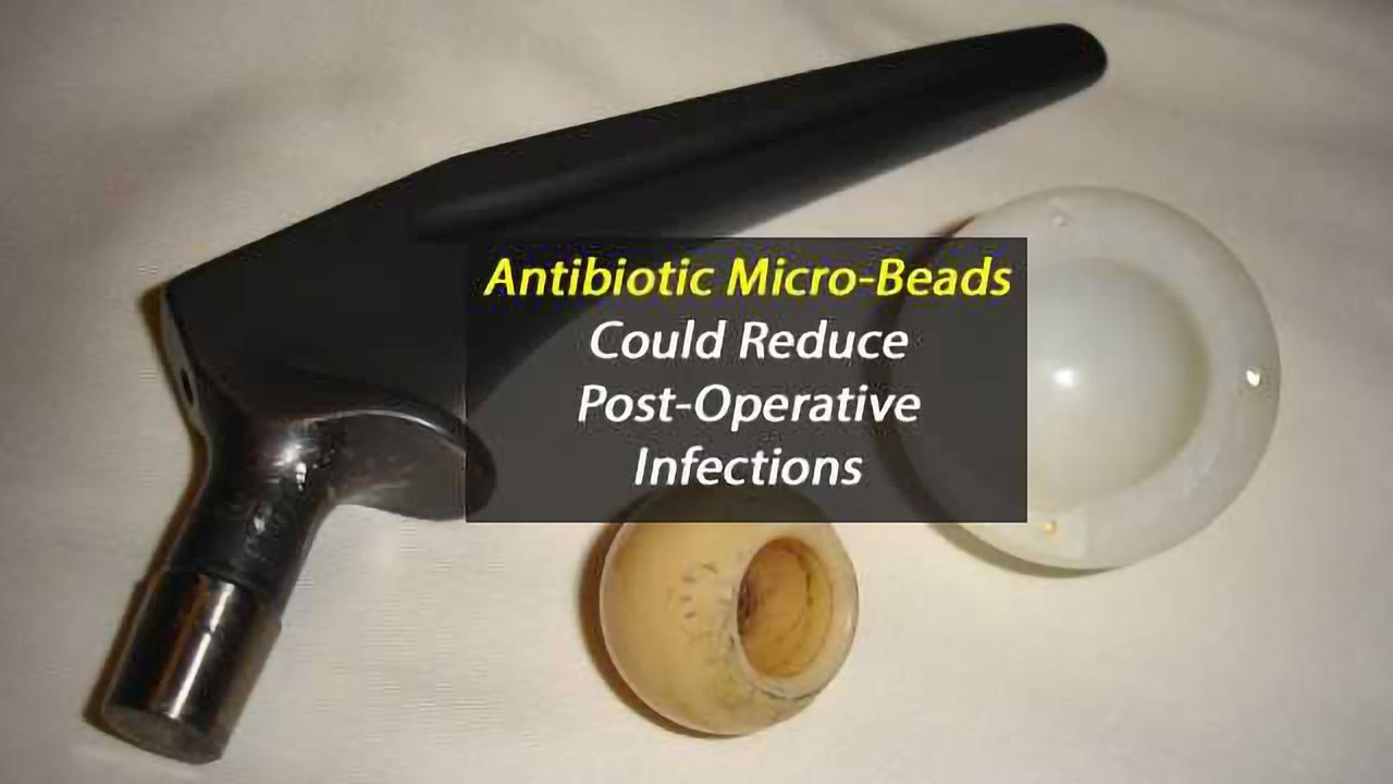 Antibiotic Micro-beads Fight Infection in Joint Replacements