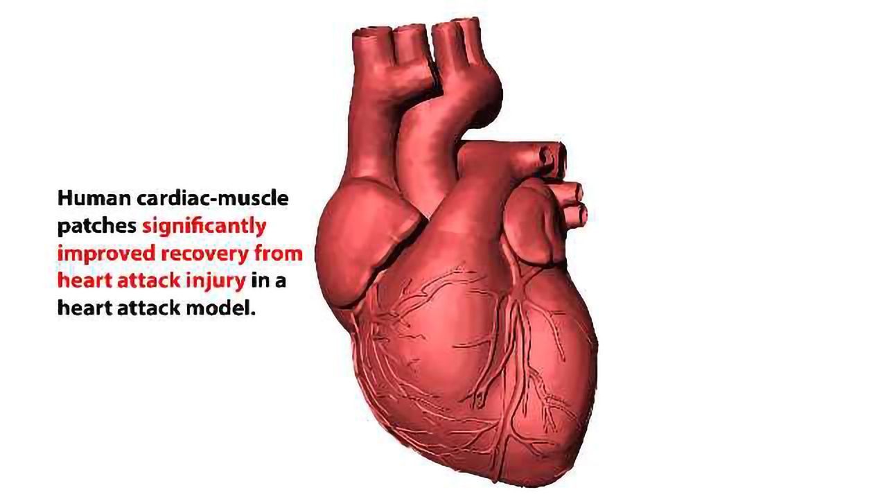 Heart-muscle Patches Created from Human Cells Improve Recovery from Heart Attacks