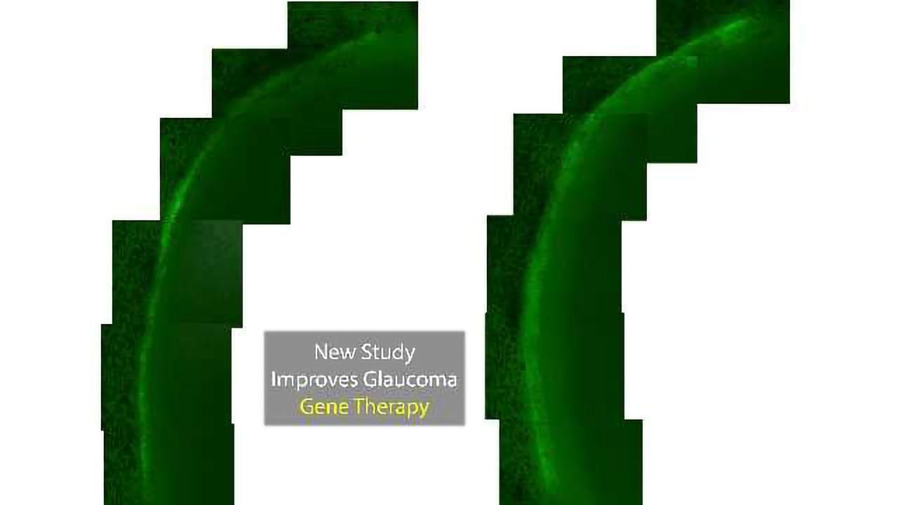 Proteasome Blocker Brings Glaucoma Gene Therapy Closer