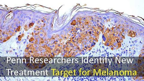 New Treatment Target for Melanoma