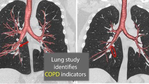 Genetic Variations in the Lungs Identify COPD Risk