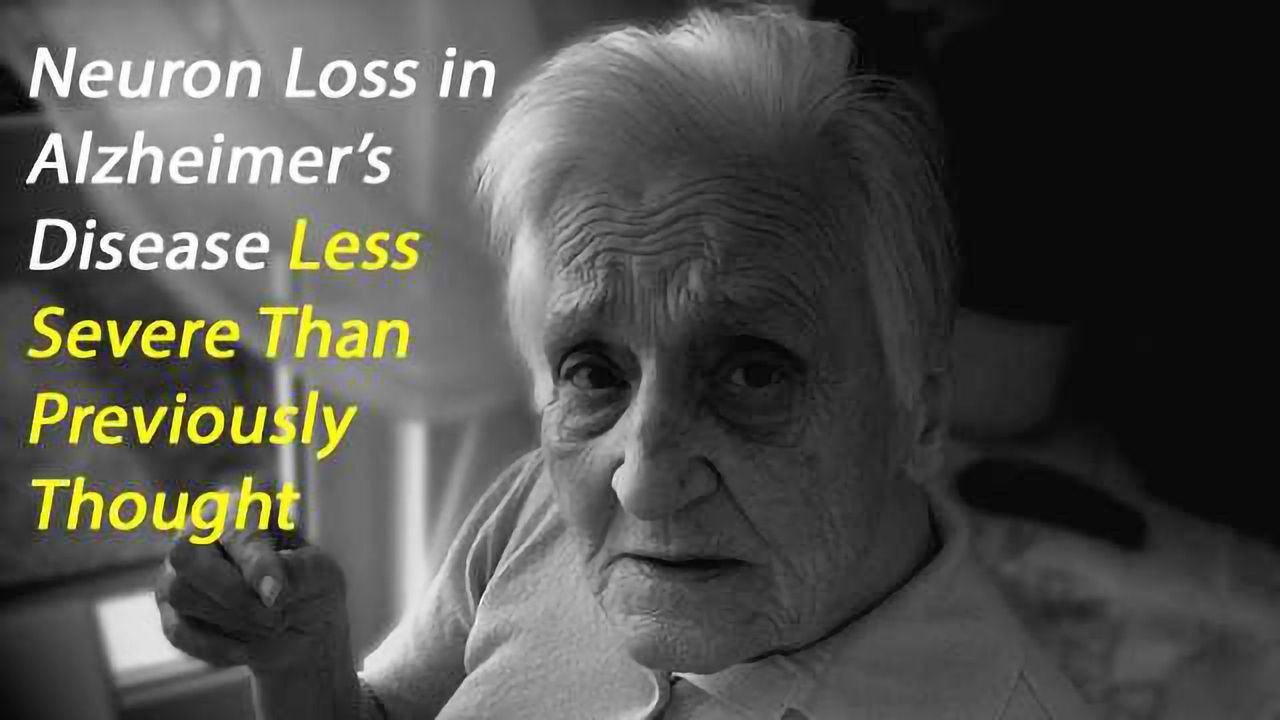 Neuronal Loss in Alzheimer's Disease Only Moderate