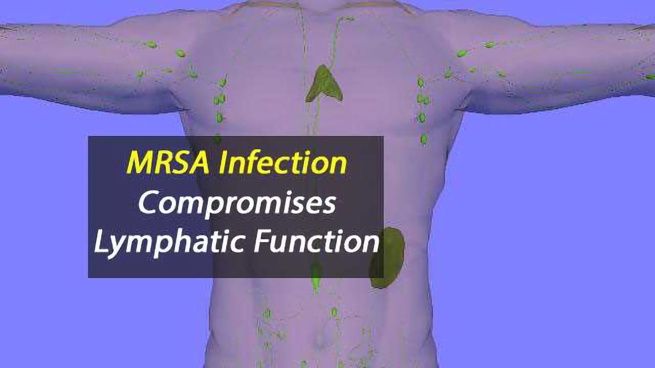 Study Reveals How MRSA Infection Compromises Lymphatic Function