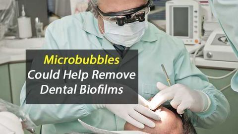 Microbubbles Could Help Remove Dental Biofilms