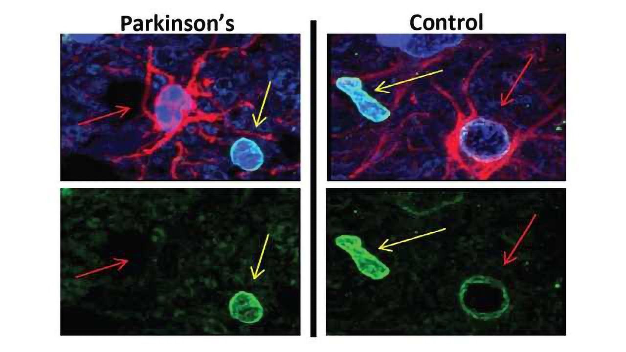Therapeutic Avenue for Parkinson's Disease?