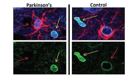 Therapeutic Avenue for Parkinson's Disease?