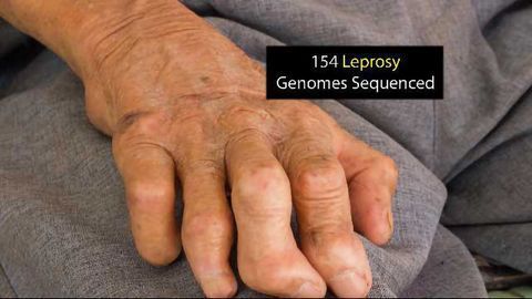 Sequencing of Leprosy Genome Could Provide Vital Answers to Drug Resistance Mechanisms