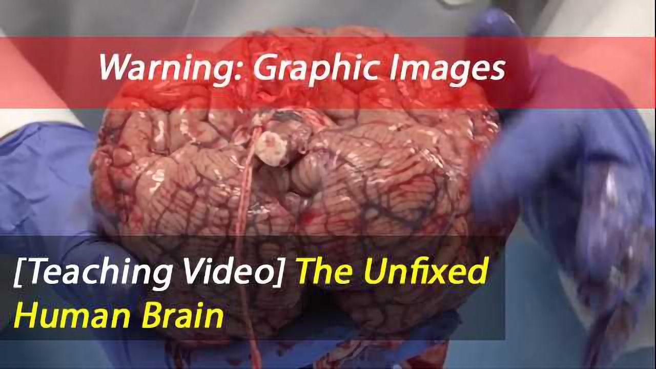 The Unfixed Brain from a Recent Autopsy
