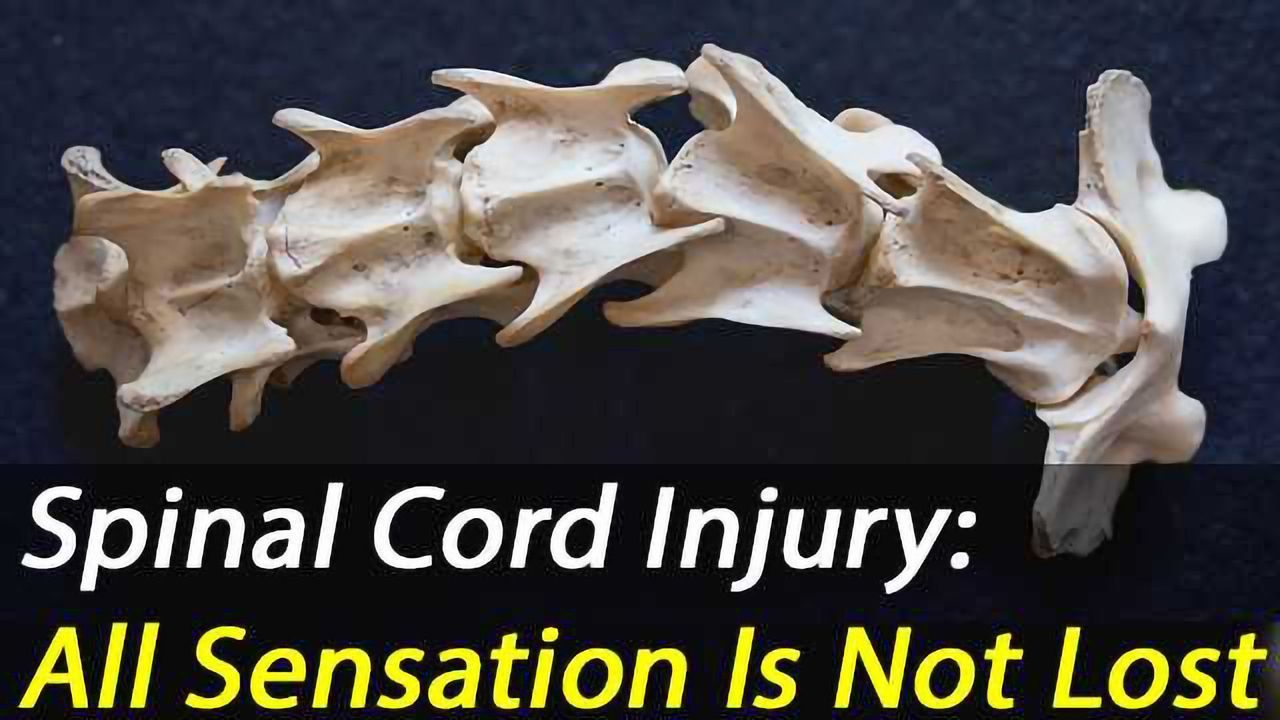 Thoracic Spinal Cord Injuries: MRI shows sensory neurons are preserved in 50% of cases