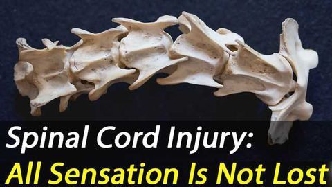 Thoracic Spinal Cord Injuries: MRI shows sensory neurons are preserved in 50% of cases