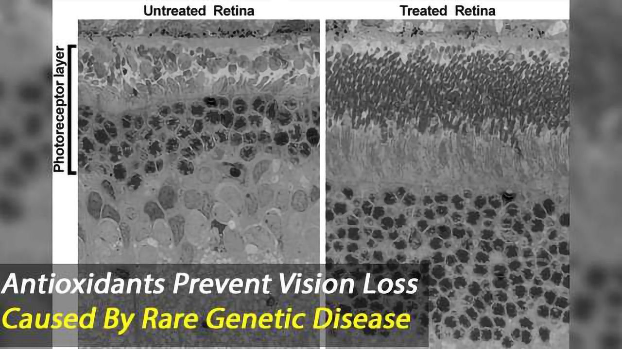 Evidenced-Based Antioxidant Therapy Prevents Vision Loss Caused by Smith-Lemli-Opitz Syndrome