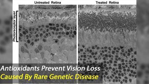Evidenced-Based Antioxidant Therapy Prevents Vision Loss Caused by Smith-Lemli-Opitz Syndrome