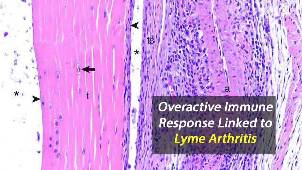 Missing Link Identified Between the Immune System and Lyme Arthritis