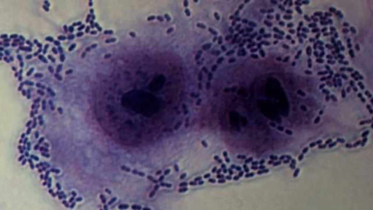 E-cig Vapour May Aid Infection by Pneumonia-causing Bacteria