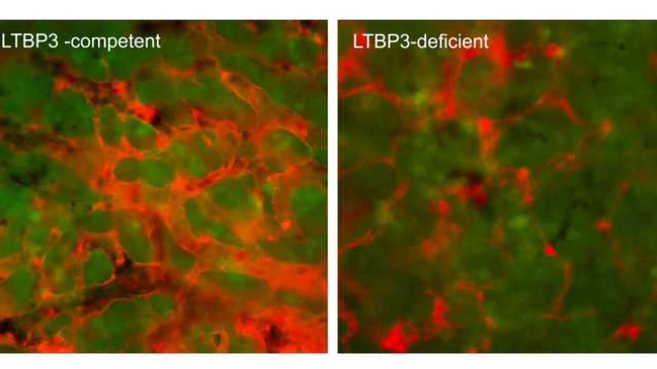 Step Toward Stopping Cancer Metastasis