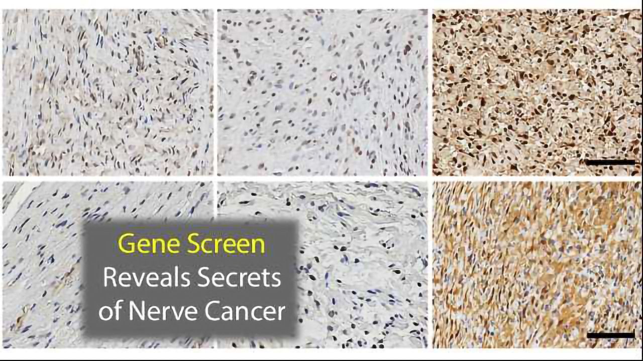 Tumor Gene Screen Gives Insight Into Nerve Cell Cancers