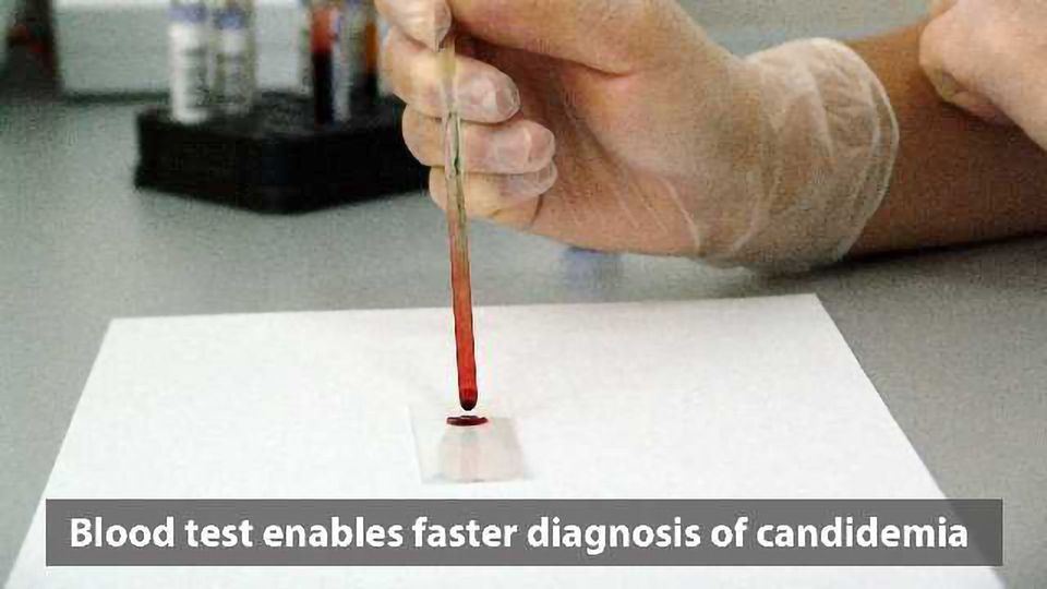 Blood Test Cuts Time to Diagnosis for Common, Deadly Yeast Infection