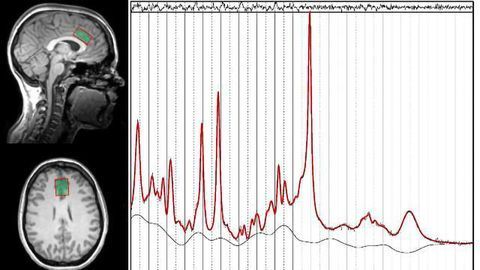 Increased Glutamate Imaged in Addiction Areas of the Brains of Alcoholics