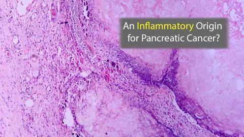 The Inflammatory Path to Pancreatic Cancer