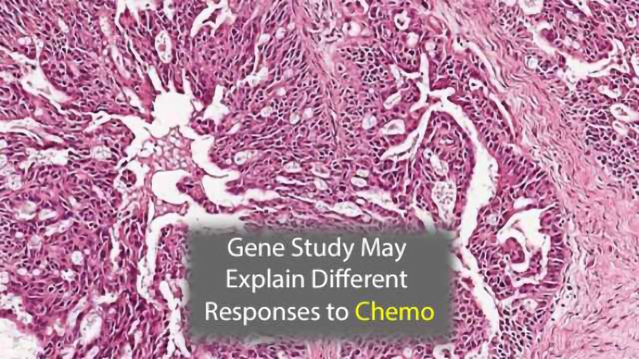 Drug Transport Gene May Explain Why Ovarian Cancer Patients React Differently to Chemotherapy