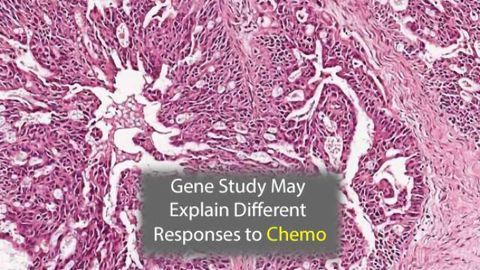 Drug Transport Gene May Explain Why Ovarian Cancer Patients React Differently to Chemotherapy